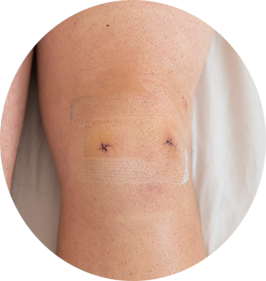 Knie-Textbild Meniskusnarbe nach eine Meniskus Operation