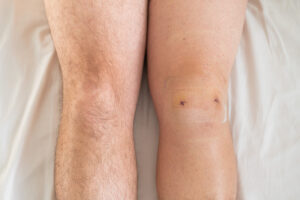 Therapiemethoden zur Behandlung von Meniskusproblemen.