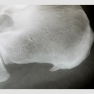 Der Fersensporn - Schmerzen - effektive Fussschmerztherapien bei René Teichert