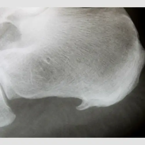 Der Fersensporn - Schmerzen - effektive Fussschmerztherapien bei René Teichert