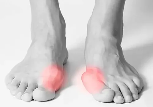 Therapiemassnahmen zur Schmerzlinderung bei Hallux.