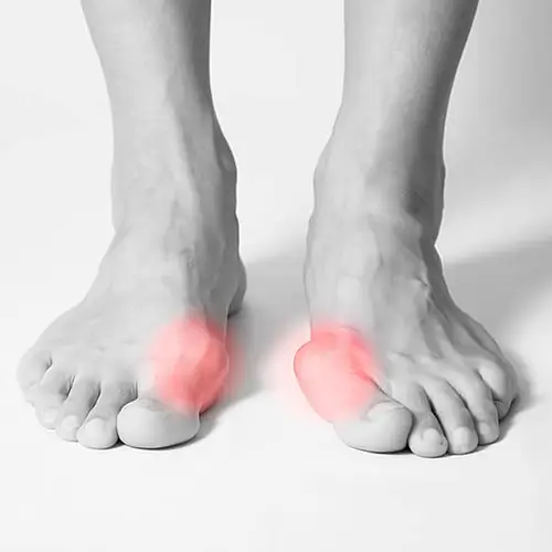 hallux-zehenschmerzen Therapiemassnahmen zur Schmerzlinderung bei Hallux.